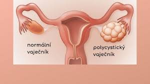 přibírání na váze po vysazení antikoncepce o