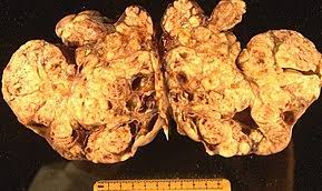 This occurs primarily in children and teens and is rare by comparison to epithelial ovarian tumors. Ovarian Cancer Wikipedia