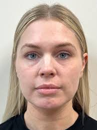 Upper face Filler in El Dorado Hills, Sacramento & Rocklin