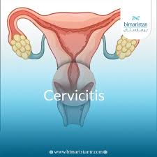 Image result for Acute Cervicitis
