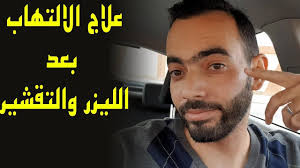 علاج الالتهابات من الليزر والتقشير Youtube