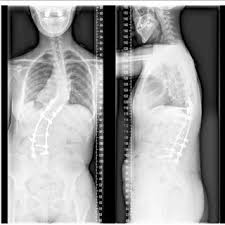 But after refusing to give up on his goal, burgos is now earning plenty of admirers in the ufc. Pdf Kyphoscoliosis With Klippel Trenaunay Syndrome A Case Report And Literature Review