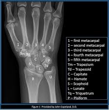 Check spelling or type a new query. Figure Wrist X Ray With Labeled Osseous Anatomy Contributed By John Copeland Do Statpearls Ncbi Bookshelf