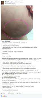 When a cancer grows within the breast, it distorts the normal architecture of the breast tissue, which can then distort the look of the overlying breast skin. Fibrocystic Breasts