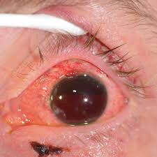 Image result for Hyphema