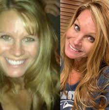 Is robotic-assisted knee replacement surgery worth it?