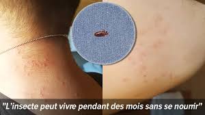 Aug 17, 2020 · les punaises de lit ne sont pas dangereuses et ne transmettent pas de maladies, mais elles piquent les humains pour sucer leur sang et laissent des petits boutons rouges sur la peau qui démangent. Sebastien A Ete Pique Par Des Punaises De Lit Un Insecte En Recrudescence Dans Nos Contrees Les Demangeaisons Le Soir C Est Affolant Rtl Info