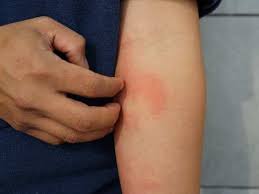 Rashes are one of the most common skin problems for adults, children, and babies. Coronavirus Symptoms Skin Rash Could A Prominent Symptom Suggests A Study The Times Of India