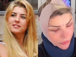 Íris Stefanelli passou por plástica que promete “levantar” o rosto; entenda  o método