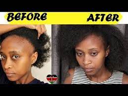 How To Treat Bald Hair And Regrow Your Bald Hair Spot Naturally Youtube Regrow Hair Naturally Thick Hair Remedies Hair Remedies For Growth