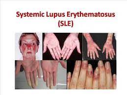 National institute of arthritis and musculoskeletal and skin wallace dj. Systemic Lupus Erythematosus Currae