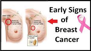 See a gp as soon as possible if you notice any symptoms of breast cancer, such as an unusual lump in your breast or any change in the appearance, feel or shape of your breasts. Warning Signs Of Breast Cancer Faculty Of Medicine