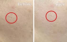 アイス ピック 型 ニキビ 跡