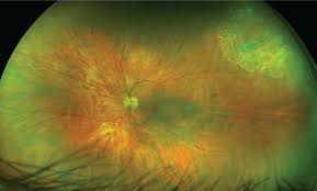 A patient with an acute retinal tear may experience the sudden onset of black spots or floaters in the affected eye. Five Evidence Based Answers For Pvd Retinal Breaks