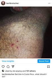 Image result for Bat Bite