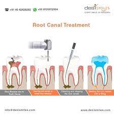Get Rct Molar Anterior Tooth Re Rct In Hyderabad Find Prices Best Endodontists General Dentists And Denta Root Canal Root Canal Treatment Dental Implants