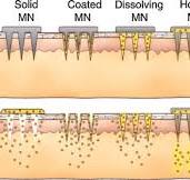 Dissolving microneedles for transdermal drug delivery ...
