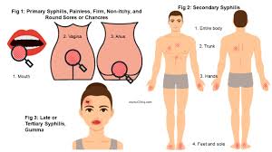 Image result for syphilis symptoms