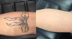We would like to show you a description here but the site won't allow us. Tattoo Removal Gratis Konsultation Hos Rewind Se Mere
