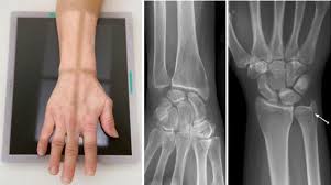 Extensor carpi ulnaris — extensor carpi ul·nar·is.əl nar əs n a muscle on the ulnar side of the back of the forearm that extends and adducts the hand … medical dictionary. 2 Pa View Should Profile The Extensor Carpi Ulnaris Tendon Groove Download Scientific Diagram