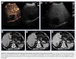Unenhanced Ct Scan Meaning Ct Scan Machine