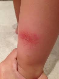 Bug Bites That Look Like Mosquito Bites But Aren T My Son S Severe Reaction To Bug Bites In Particular Mosquito The Only Thing I Ve Found Bug Bites Remedies Remedies For Mosquito Bites Insect Bites On Babies