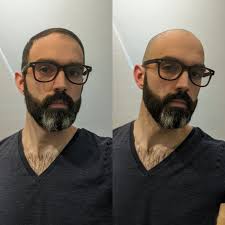 Well that's great for people with hair, but i know from personal experience that there are a lot of balding men out there and there are almost no articles out there on how to look good bald. Quarantine Head Shaving Becomes Permanent As Some Embrace The Bald Vox