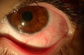 Image result for Vernal Conjunctivitis