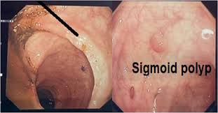 Image result for Colonoscopy in GI Bleeding
