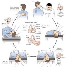 Image result for Vertigo Management