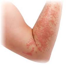 Image result for contact dermatitis