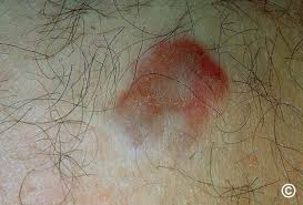 Image result for Dermatofibrosarcoma Protuberans