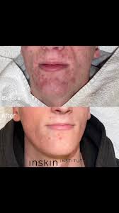 Acne 🧖🏽‍♀️ * Acne is a skin condition that we often see in the clinic. It  can occur at both young and old age and can have a major impact