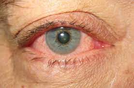 Acute Conjunctivitis Symptoms Diagnosis And Treatment Bmj Best Practice Us