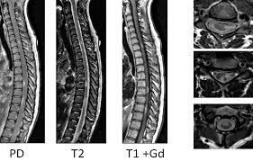 Multiple sklerose beginnt oft lange vor der diagnose. Multiple Sklerose Neuroradiologie Bringt Licht Ins Dunkel Der Krankheit Und Unterstutzt Diagnose Und Therapie Neuroradiologie De