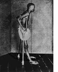 Although beriberi can occur in anyone who is poorly nourished, it is very the most common cause of beriberi in the united states is alcoholism. Thiamine Deficiency Wikipedia