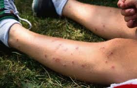 Maybe you would like to learn more about one of these? Peau A Moustique Pourquoi On Se Fait Souvent Piquer Par Des Moustiques Tout Pratique