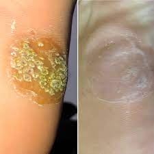For those who are looking for an option. After 4 Rounds Of Cantharidin Beetle Juice This Monster Plantar Wart Is Still Not Conquered Just Got Round 5 Hoping This Is The Final Dose The Skin Is Soft And Even Colored