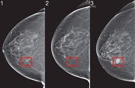 Tumors can be cancerous or benign. These Doctors Are Using Ai To Screen For Breast Cancer Wired