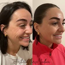 Clíodhna Hegarty RN (@aesthetic_nurse_cli) • Instagram photos and videos