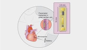 A pacemaker is a small device that's placed under the skin in your chest to help control your heartbeat. Your Next Pacemaker Might Be Implanted In Your Armpit