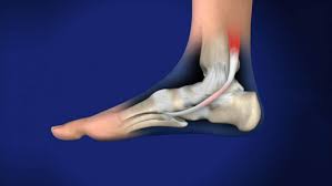 Maybe you would like to learn more about one of these? Ankle Surgery Nyc Ankle Surgery New York Ankle Surgery New York City Ankle Surgery Ny