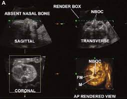 Genetic Sonography 3d Us