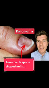 Image result for Koilonychia feet