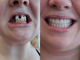 There are some that rush things and get dentures way too soon and they get a poor fitting set of dentures, and a sore mouth. Immediate Dentures Emergency Dentures Barrie Denture Clinic