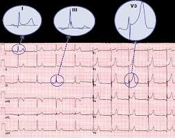 Image result for Early Repolarization