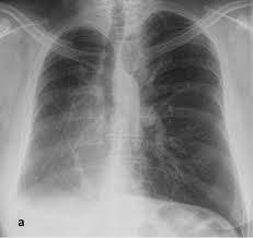 Pneumologie Unsere Krankheitsbilder Im Rontgenbild