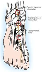 We did not find results for: Deep Peroneal Nerve Entrapment Foot Ankle Orthobullets