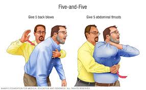 Hanging someone breaks their neck, and so kills them. Choking First Aid Mayo Clinic