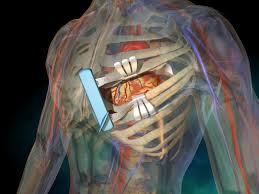 Ce alimente poate consuma un pacient cu stent la inimă medicii recomandă consumul de alimente care nu conţin uleiuri parţial hidrogenate. By Pass Sau Stent Ce Alegi Cand Ai Probleme Cu Inima Top 10 Cauze De Deces In Romania Dcnews